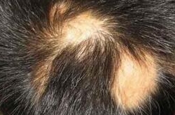 鬼剃头是怎么回事，因肝肾亏虚所致！