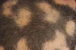 鬼剃头怎么治疗，保持轻松的精神状态！