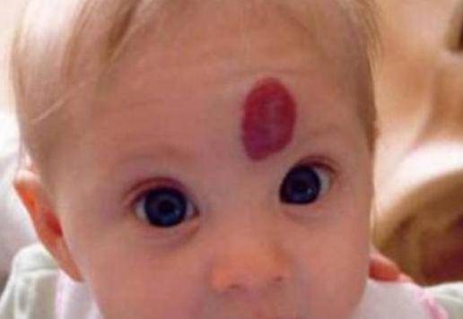 胎记是怎么形成的