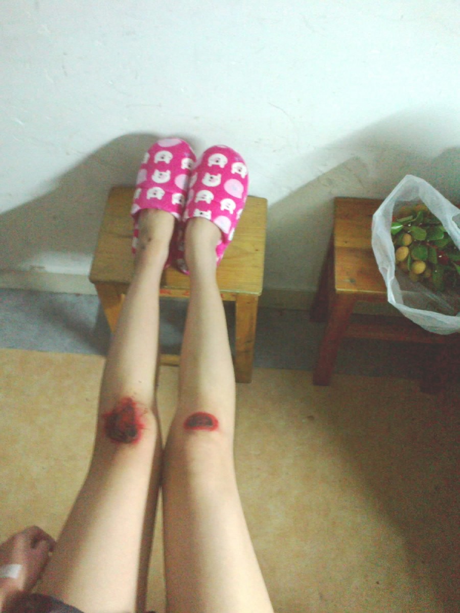 美女膝盖发紫了内涵图