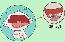 鹅口疮治疗方法 带你细了解