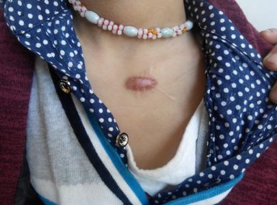 疤痕疙瘩饮食调理有哪些注意事项