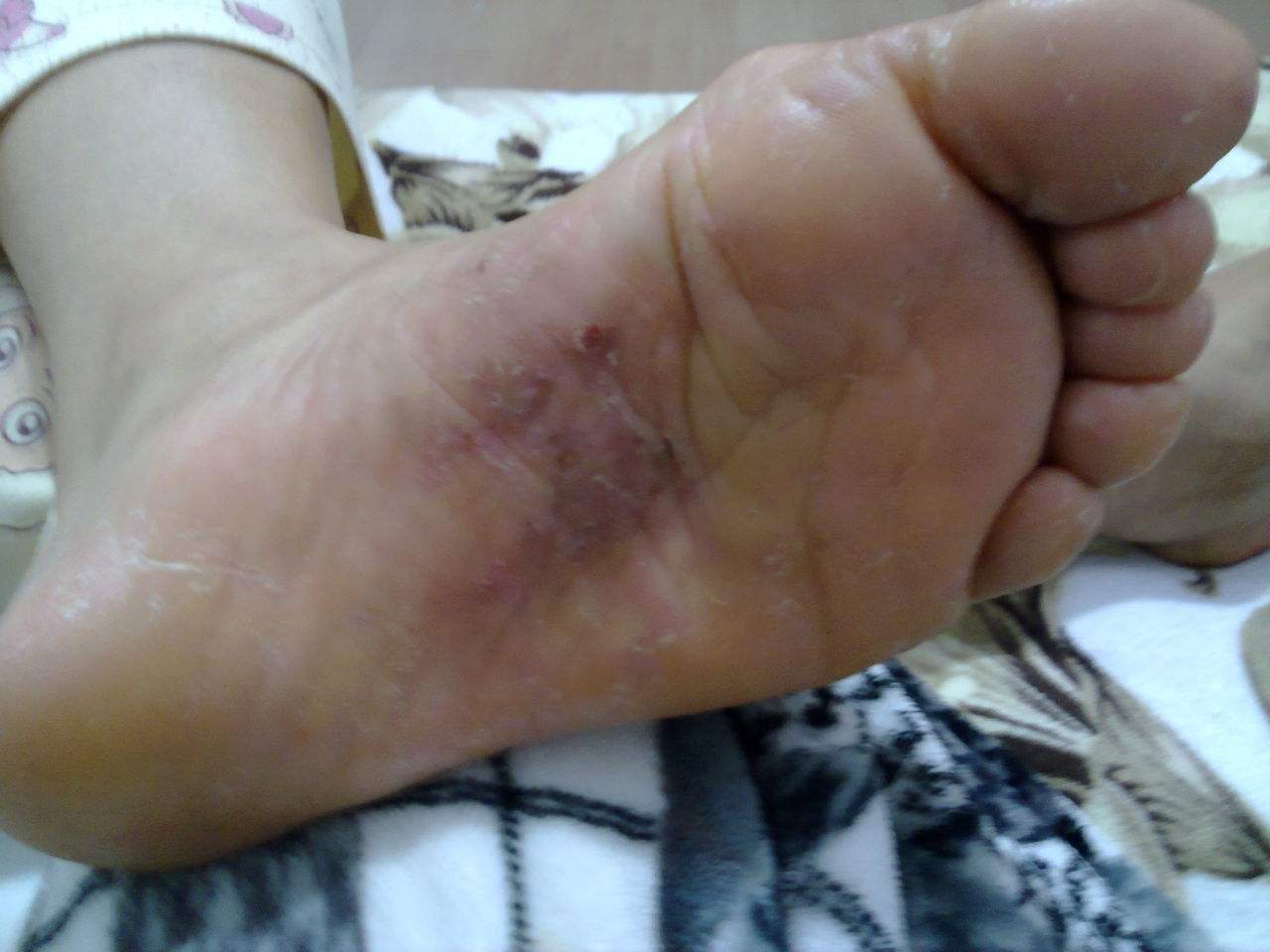 脚心痒是怎么回事 脚心痒一般是细菌感染