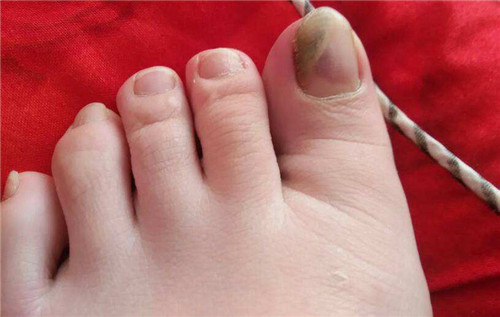 灰指甲的症状有哪些 如何治疗灰指甲又快又有效