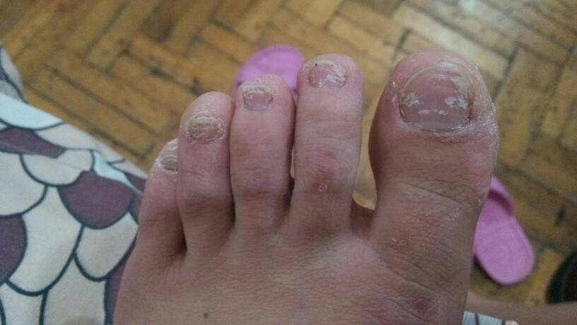 脚趾甲变厚用什么药以及有哪些治疗方法