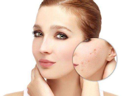 青春痘疤痕修复 几种方法让青春不留痕