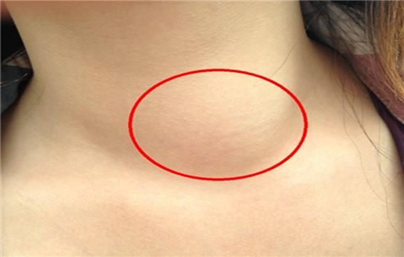 颈部淋巴 恶性肿瘤是颈部淋巴结肿大原因之一