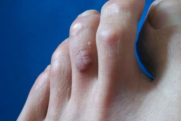 瘊子怎么去掉 瘊子的病因病机你知道多少