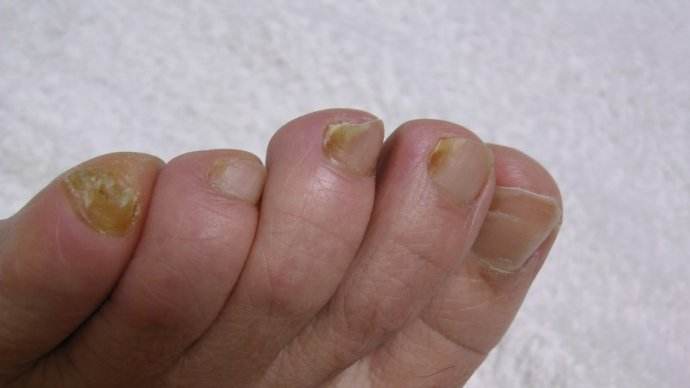 如何根治灰指甲 这些方法能根治灰指甲