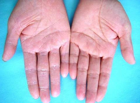 几种常见的真菌性皮肤病治疗方法