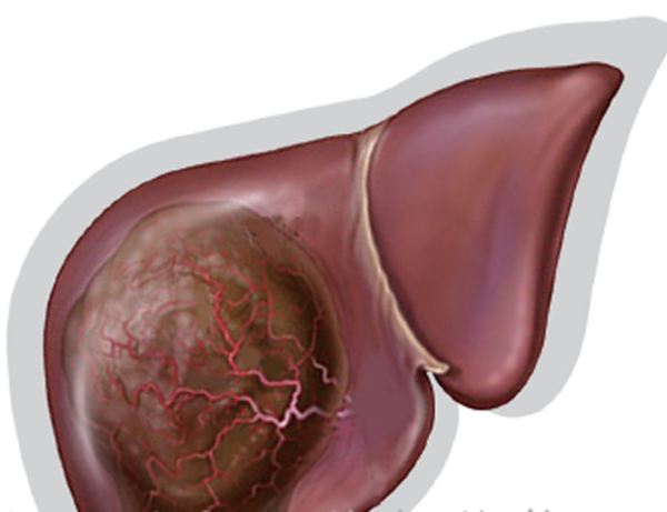 死神的召唤肝癌晚期症状你知道吗