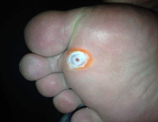 脚鸡眼的治疗方法 脚鸡眼的基本自治方法