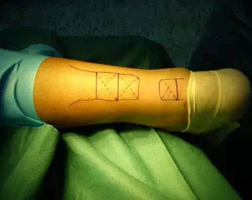 跟腱断裂紧急救自救方法