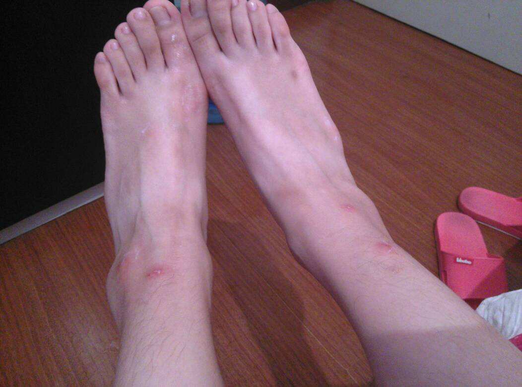 脚上长水泡怎么办 几大禁忌你必须知道才能快速的康复