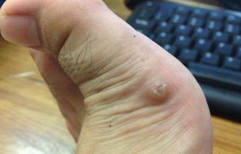 脚鸡眼的治疗方法 脚鸡眼的基本自治方法