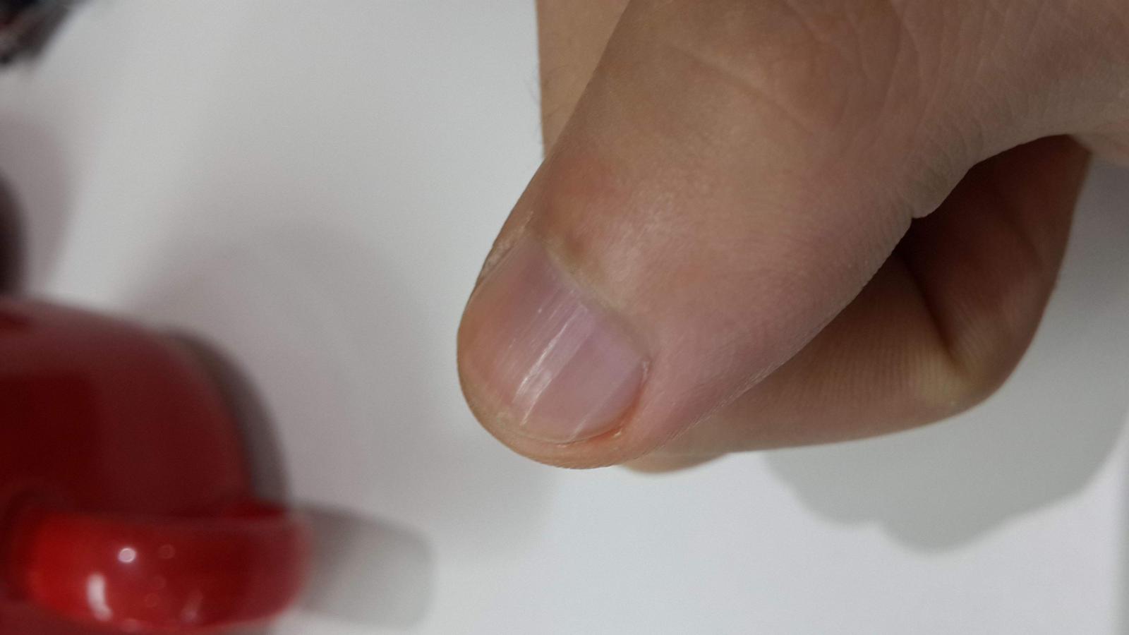 指甲有竖纹传递着怎样的健康信号