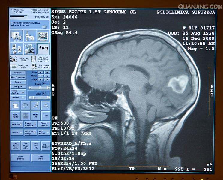 核磁共振检查什么