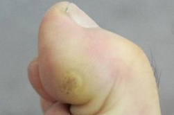 脚上长鸡眼是什么 可尝试用下面一些方法去除