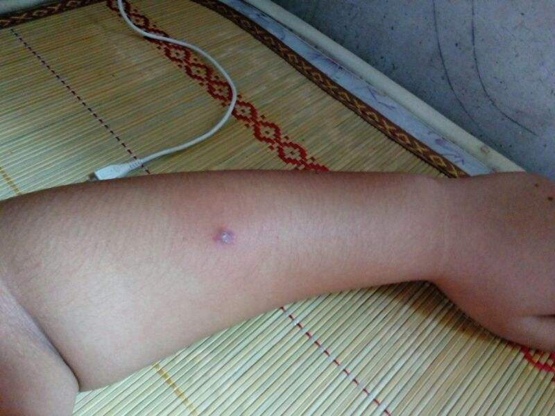 由多种原因引起的疾病腋下长疙瘩你了解吗