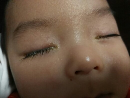 眼屎多这一症状你应该重视起来