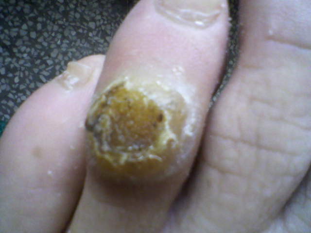 令人行动不便的脚上长鸡眼怎么治你知道吗