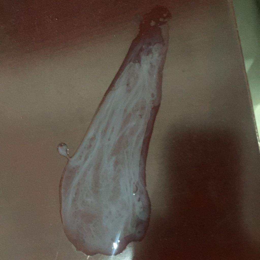 炎症遗留的瘢痕前列腺钙化灶的症状你知道吗