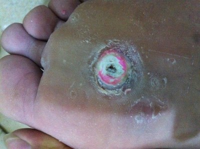 脚上长鸡眼是什么