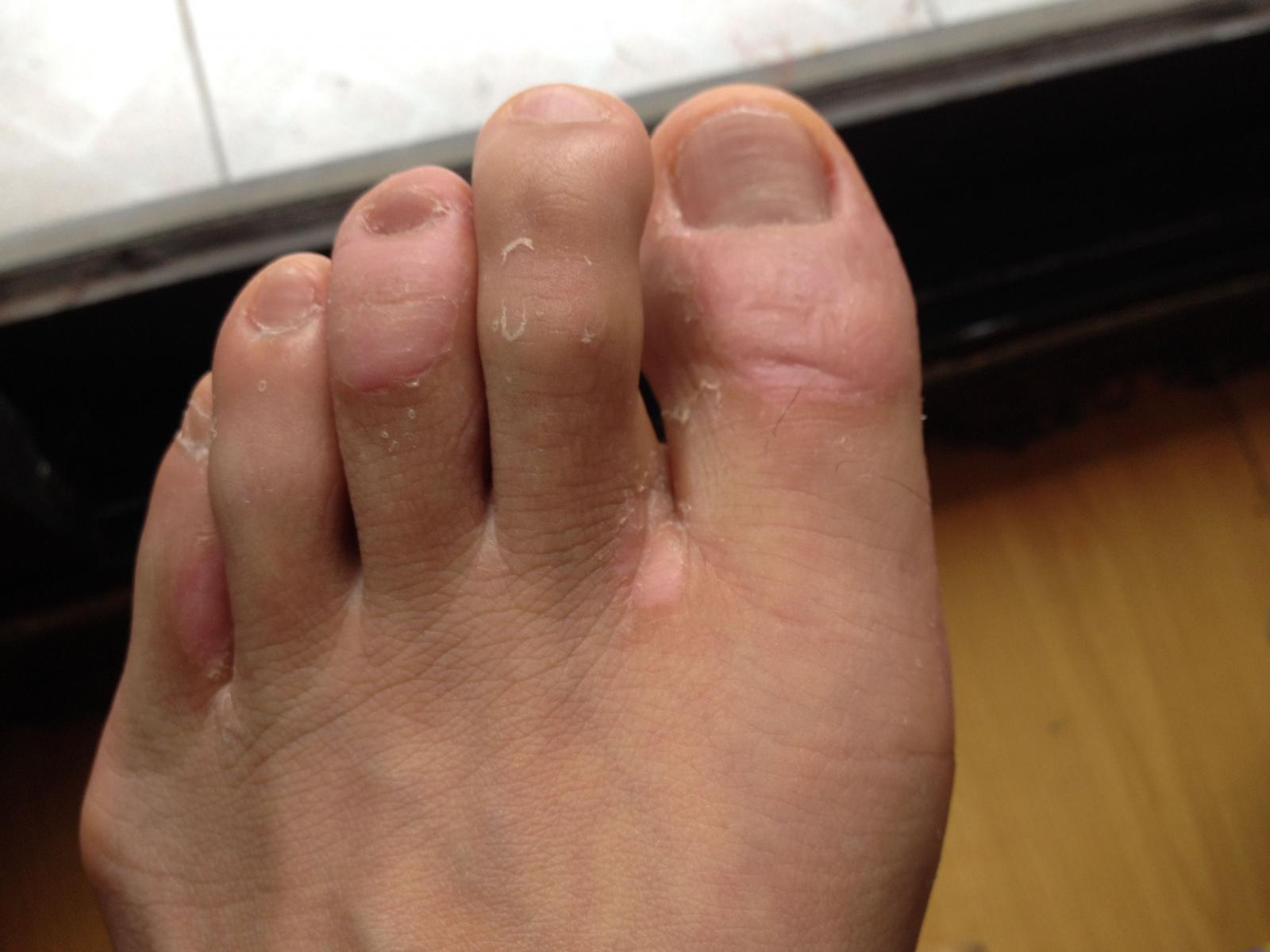 令人行动不便的脚上长鸡眼怎么治你知道吗