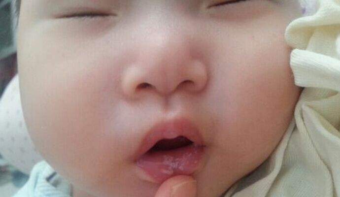 鹅口疮怎么治 几个食疗药膳轻松搞定鹅口疮