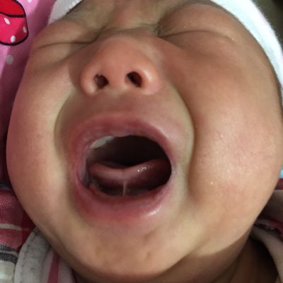 鹅口疮怎么治 几个食疗药膳轻松搞定鹅口疮