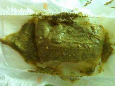 大便绿色怎么回事 绿色大便可以由很多原因引起