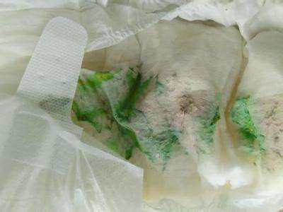 大便绿色怎么回事