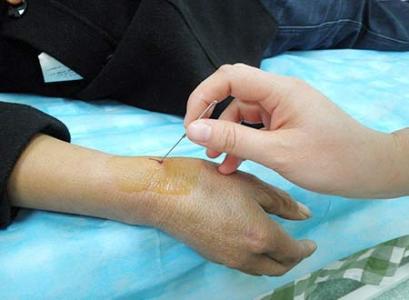 腱鞘炎怎么治疗 腱鞘炎中西医结合治疗法