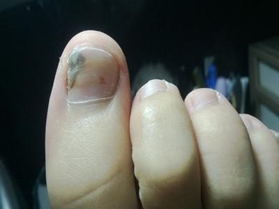 灰指甲怎么根治