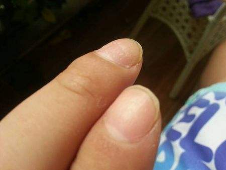 当发现手指甲有小坑了要怎么办