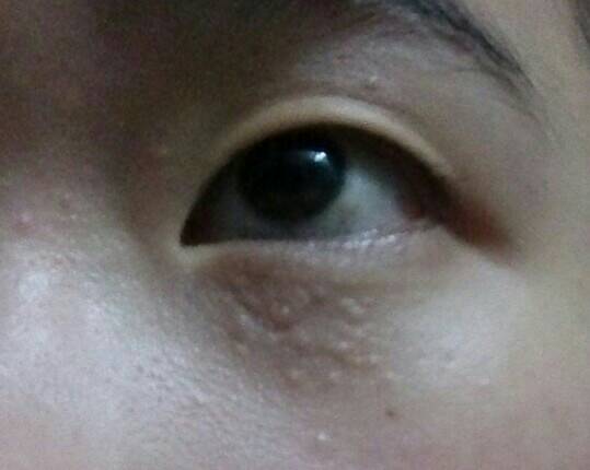 眼部疾病 眼角长脂肪粒你知道如何去除吗？