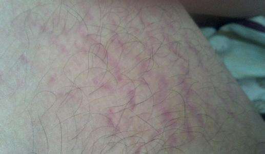 大腿肚内侧红疙瘩 及时明确病因避免盲目用药