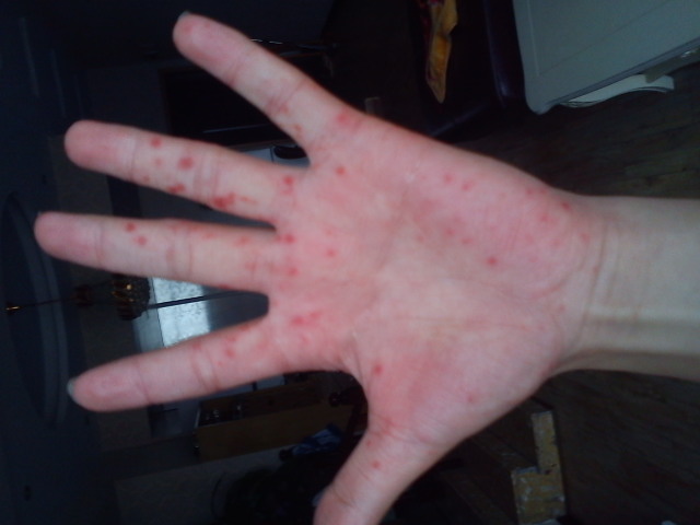 夏天手上长水泡