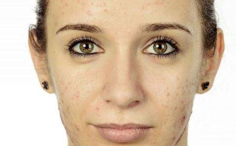 痘痘怎么消除 水果祛痘偏方