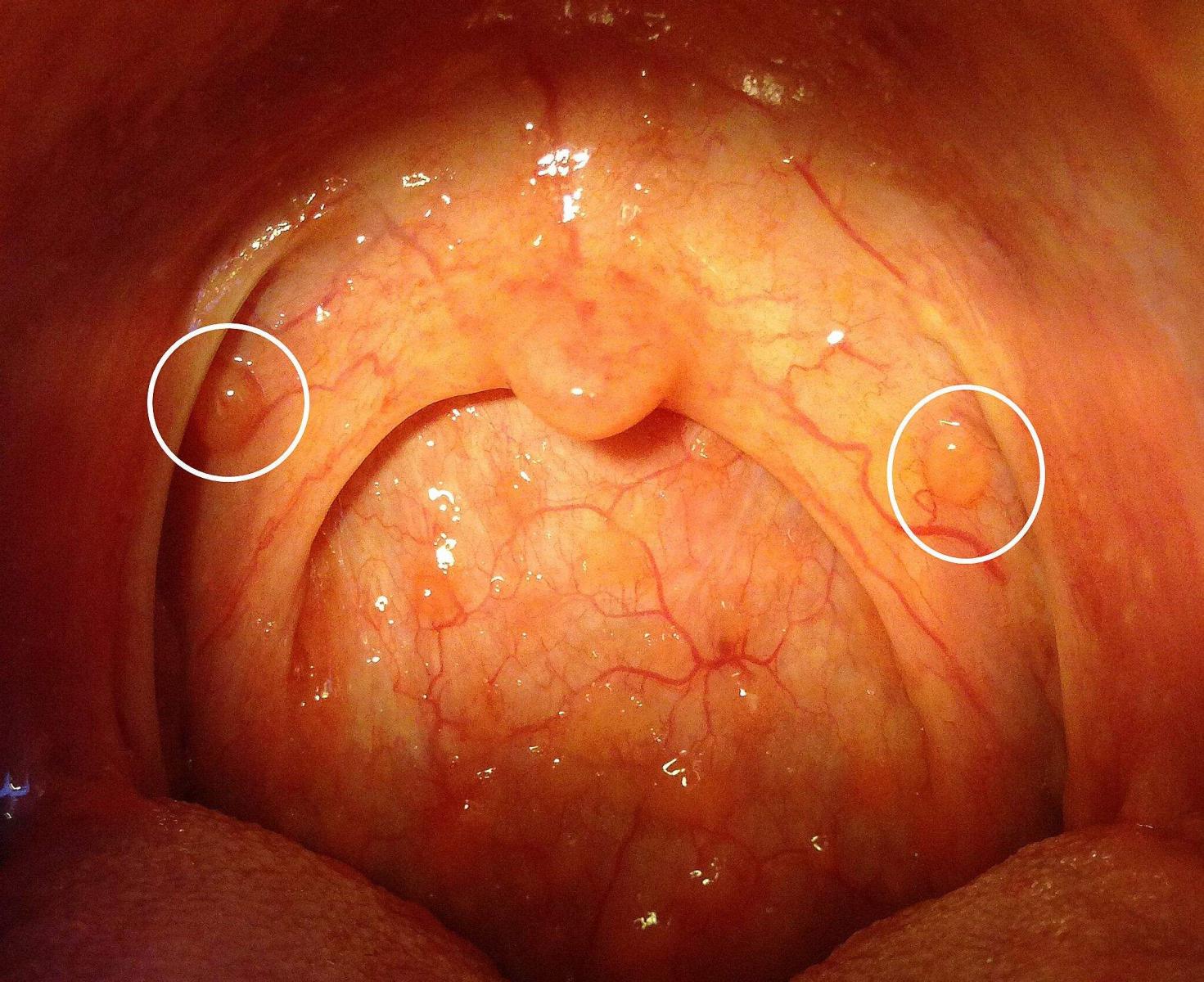 喉咙有痰咳不出来