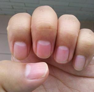 手指甲上没有月牙要引起注意说明身体不健康的表现