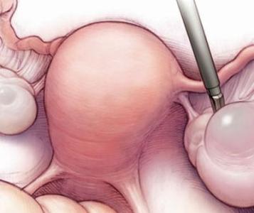 盆腔炎如何治疗 盆腔炎的食疗方法