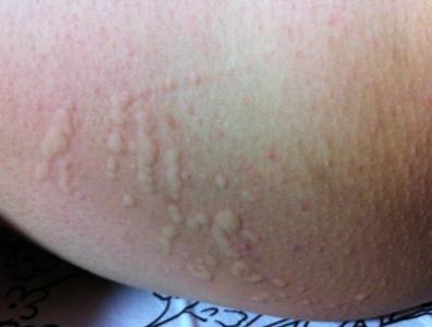 药物过敏的症状