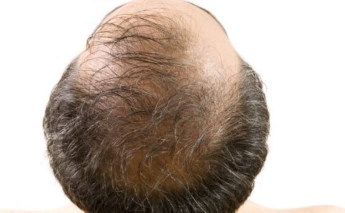 脱发原因有哪些？怎么避免脱发