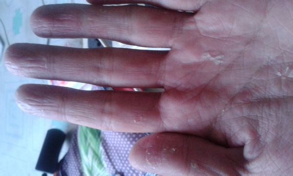 困扰大家的夏天手上长水泡的原因大家知道吗