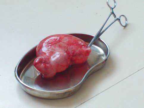 常见的妇科病之一 卵巢囊肿怎么治疗