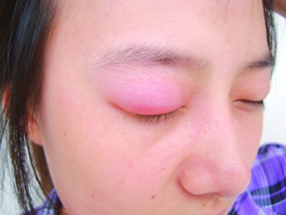 眼睛的窗户上眼皮肿是怎么回事你知道吗