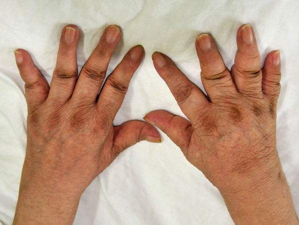 类风湿关节炎的临床表现以及类风湿关节炎的饮食疗法