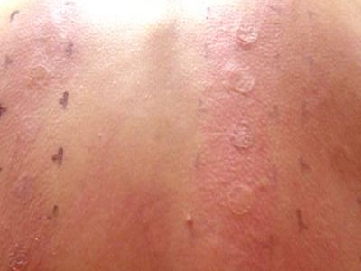 药物过敏需谨慎 药物过敏的症状