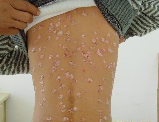 遍布全身的扁平疣是怎么引起的你知道吗